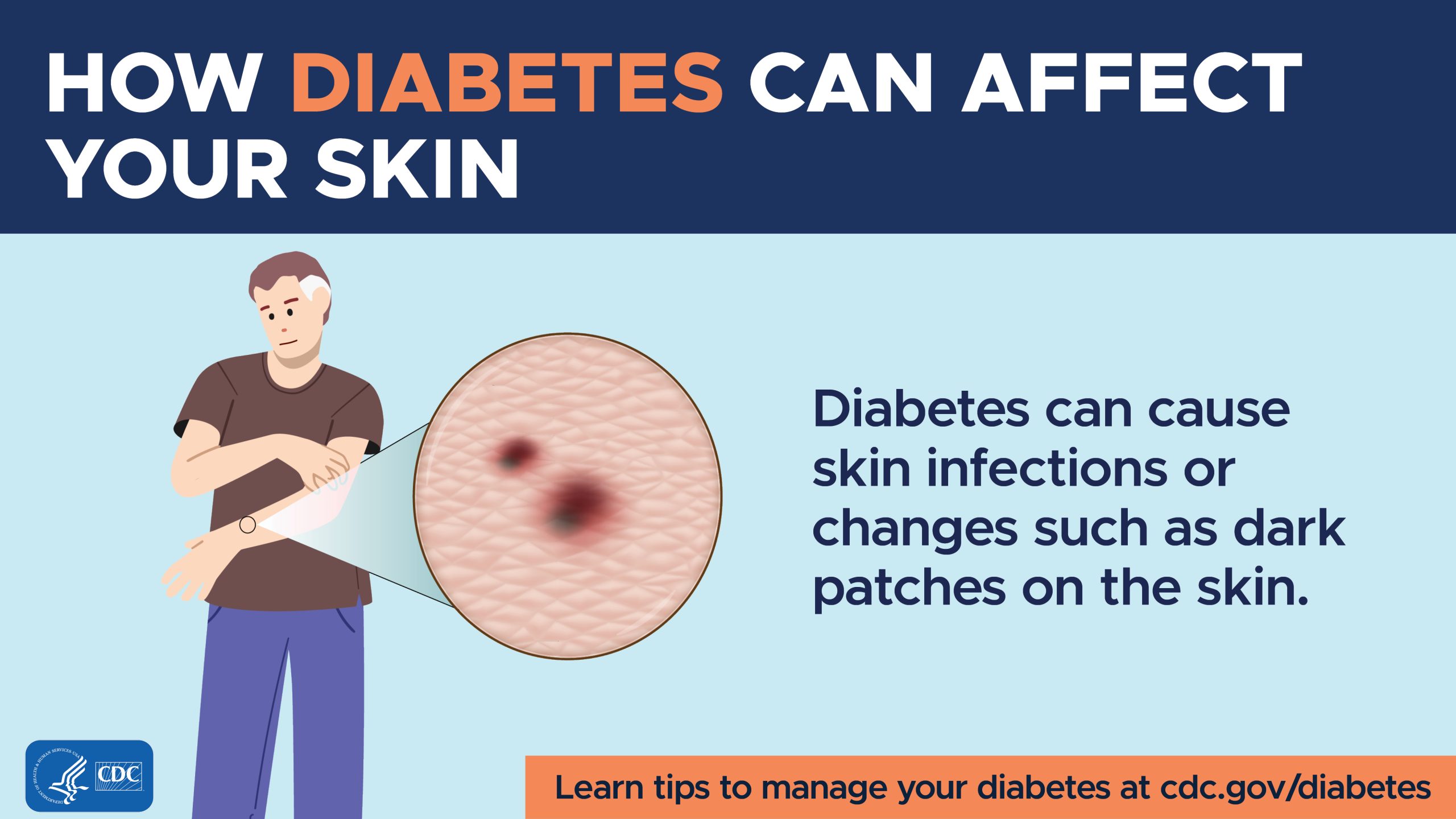 Diabetes With Skin Complications ICD-10: Code, Causes & Care